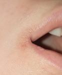 Болят уголки губ, возможно ли, что это герпес? фото 2