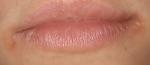 Болят уголки губ, возможно ли, что это герпес? фото 1