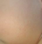 Сыпь на щеках у ребенка фото 1