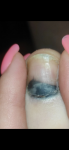 Синяк под ногтем (травма ногтя) фото 1