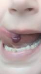 Появление гематом и кровоизлияний во рту и на коже фото 2