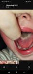 Серый налет на языке у ребенка фото 3