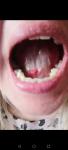 Воспаление под языком кровит фото 1