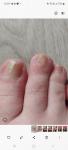 Поврежденные ногтевые пластины на ногах фото 1