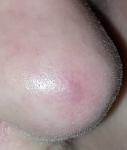 Красное пятно на носу уже год (внутри шарик) фото 1