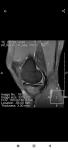 Боль колено мениск сустав артроскопия фото 4