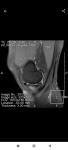 Боль колено мениск сустав артроскопия фото 3