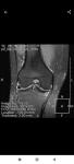 Боль колено мениск сустав артроскопия фото 2