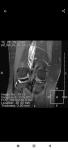 Боль колено мениск сустав артроскопия фото 1