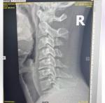 Лечение остеохондроза, дефспондилёза, унковертебрального артроза фото 2