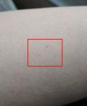 Появились мелкие красные точки на коже, похожие на укол иголкой фото 3