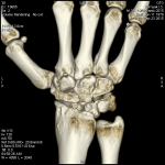 Старый перелом ладьевидной кости руки фото 2