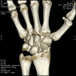Старый перелом ладьевидной кости руки фото 4