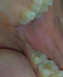 Белые помутнения слизистой рта фото 1