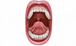 Удаление зуба мудрости, опухоль под языком фото 1