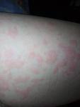 Аллергия на спине и ногах фото 1