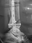 Осколок малоберцовой кости после остеозинтеза лодыжки фото 1