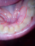 Твердые шишки на десне нижней челюсти внутри фото 2