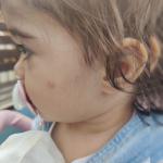 У ребенка налица и локте воспалительное образование фото 1