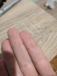 Сухость кожи на пальце руки фото 1