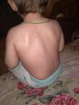 Сыпь по телу у ребенка после лечения антмбиотиком фото 5
