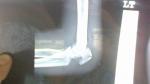 Перелом локтевого отростка со смещением операция фото 3