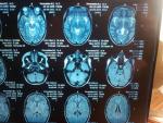 Расшифровать МРТ головного мозга фото 5