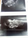 Трубная беременность фото 4
