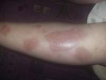 Аллергия на укусы насекомых и пятна на коже ниже колена! фото 3