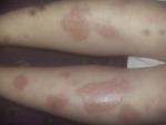 Аллергия на укусы насекомых и пятна на коже ниже колена! фото 1