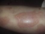 Аллергия на укусы насекомых и пятна на коже ниже колена! фото 2