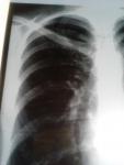 Пневмания или туберкулез фото 5