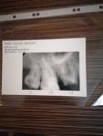 Болит зуб после удаления нерва фото 1