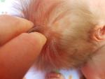 Сосочкообразное образование на волосистой части головы у новорожденного фото 2