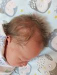 Сосочкообразное образование на волосистой части головы у новорожденного фото 1