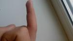 Сыпь на среднем пальце фото 2