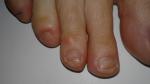 Подозрительная кожа на ногтях и пальцах фото 2