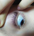 Пятнышко на белке глаза фото 2