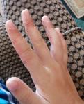Как вылечетить зуд на пальцах? фото 1