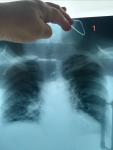 Снимки по пневмонии фото 1