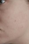 Сыпь на лице после аллергии фото 1