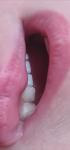 Белые пятна на зубах фото 1