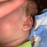 Сыпь на лице младенца фото 3