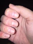 Атопический дерматит, грибок кожи рук и ногтей, что это? фото 4