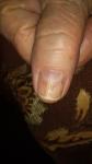 Пятно на ногте большого пальца руки фото 1