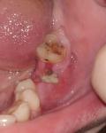 Боли спустя 6 дней после удаления зуба фото 1