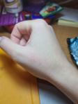 Дерматит или аллергия на руках фото 3