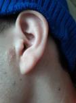 Маленький красные пупырышки в наружной части левого уха фото 3