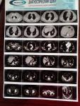 Правильно ли поставлен диагноз по простате по МРТ фото 1