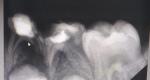 Показано ли удаление зуба фото 1